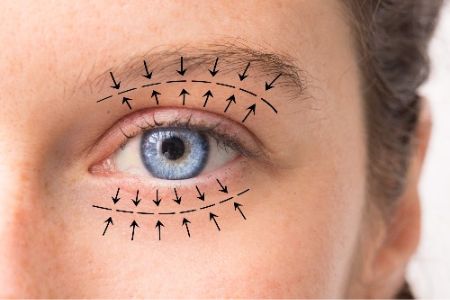 Blepharoplasty