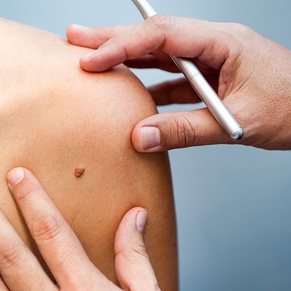 Mole, Wart & Skin Tag Removal