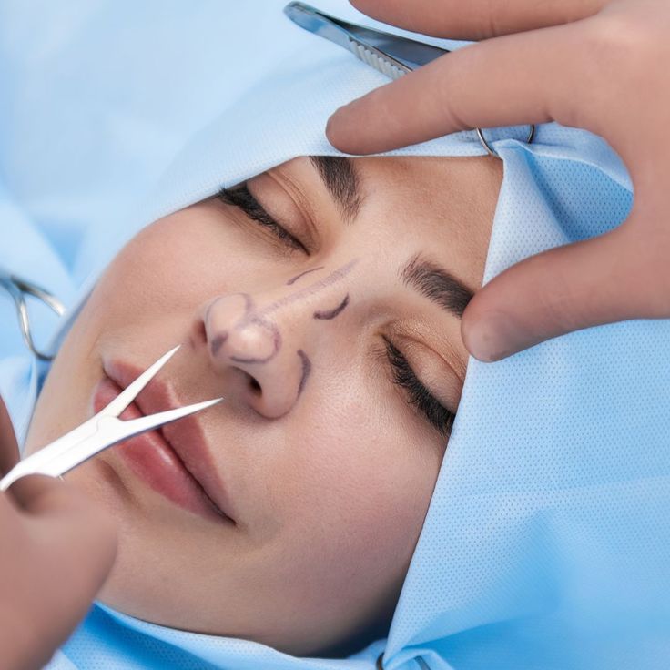 Surgical Rhinoplasty