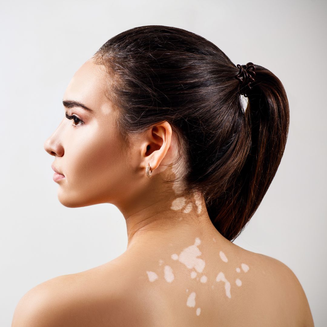Vitiligo, Eczema & Psoriasis Management